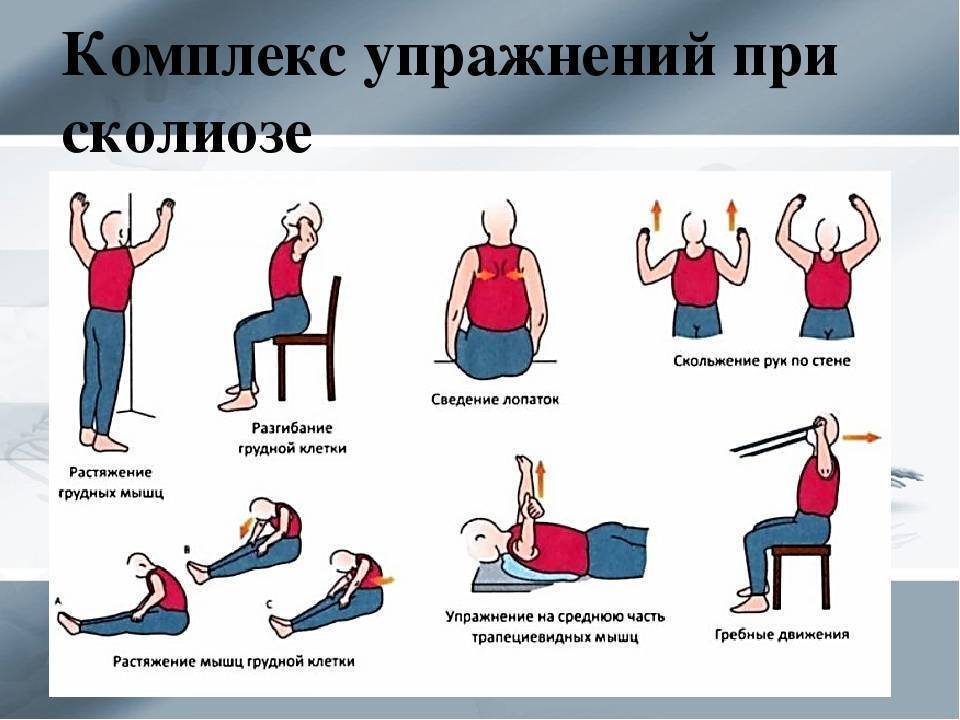Лфк и упражнения при сколиозе 1 и 2 степени у детей