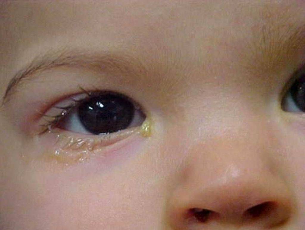 Гноятся глаза у ребенка: что делать в домашних условиях и чем лечить гнойные выделения?