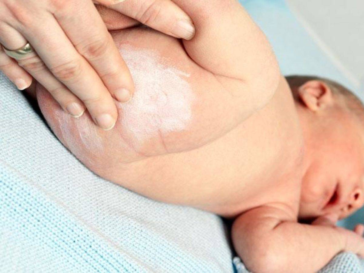 Заболевания новорожденных уход. Подкожный адипонекроз новорожденных. Пеленочный дерматит у младенца. Пеленочный дерматит у новорожденных.