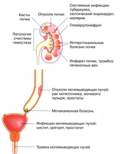 Причины появления крови в моче
