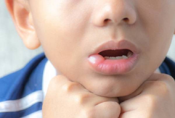 Опухла щека у ребенка с одной стороны: возможные причины, диагностика и особенности лечения