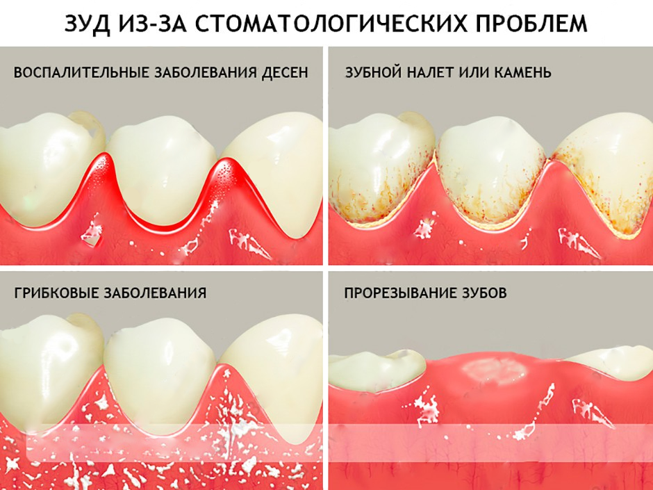 Налет на зубах у ребенка: причины белых, желтых, черных и коричневых отложений
