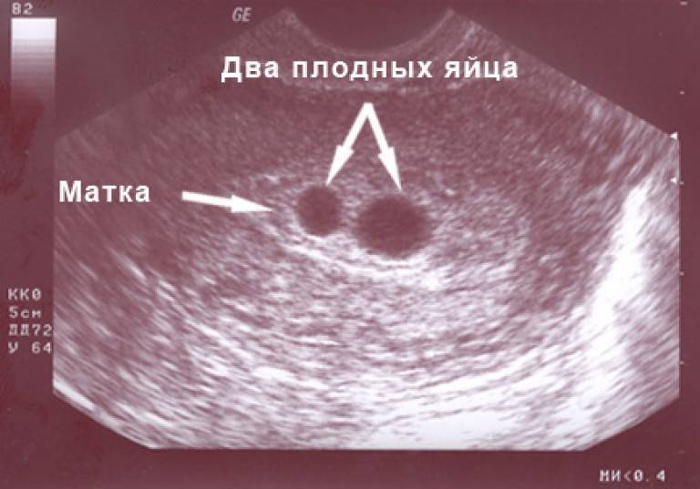 Можно увидеть эмбрион плодном яйце. когда на узи виден эмбрион