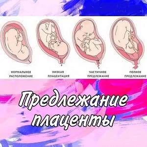 Плацента по передней стенке: что это значит при беременности