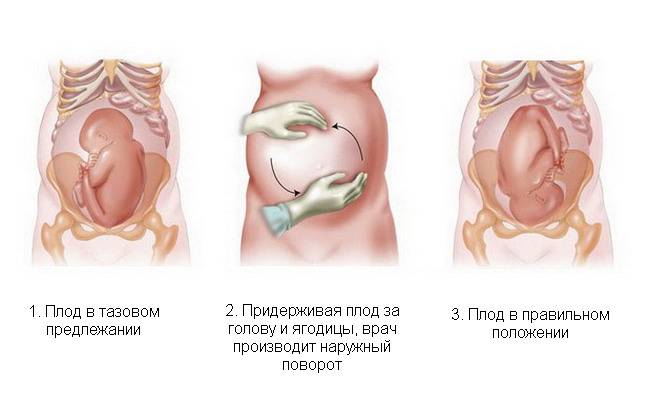 Кесарево сечение при тазовом предлежании: когда делают, как проходит, какие плюсы и минусы операции?