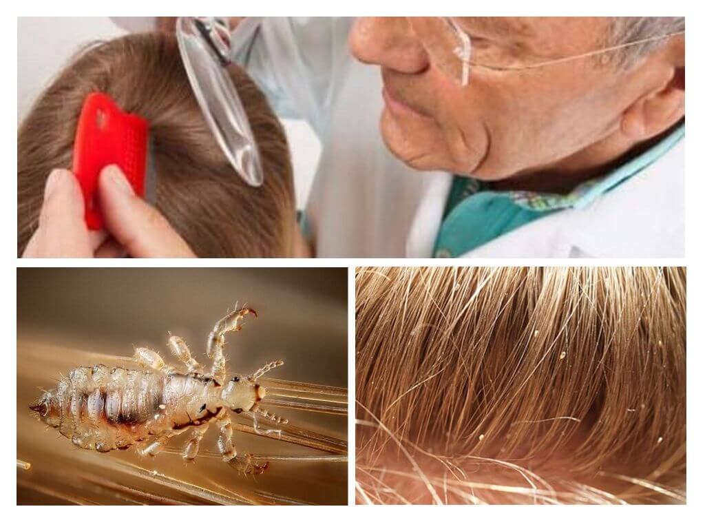 Вши у ребенка: что делать, как лечить педикулез в домашних условиях, фото как выглядят вши и гниды в волосах у детей