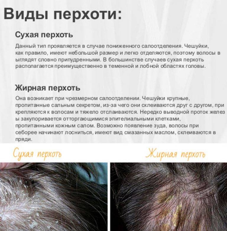 Себорейный дерматит волосистой части головы: лечение, фото
