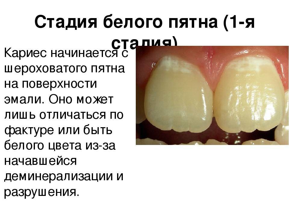 Жёлтые зубы у ребенка