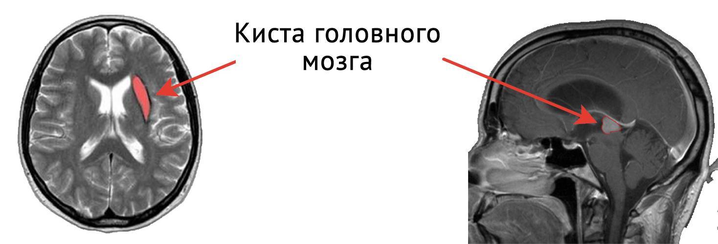 Субэпендимальная киста у новорожденного ребенка: симптомы, лечение, последствия — med-anketa.ru