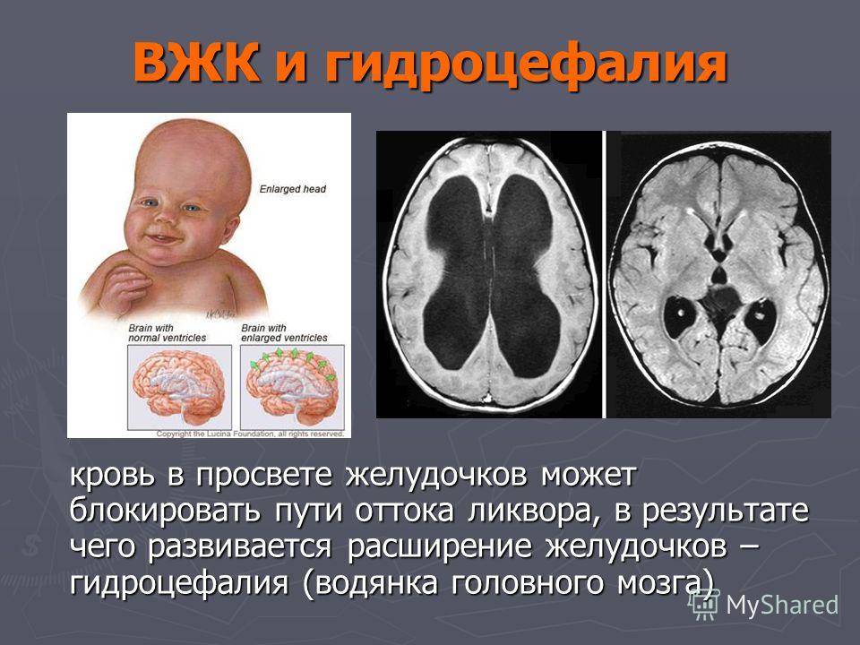 Киста головного мозга