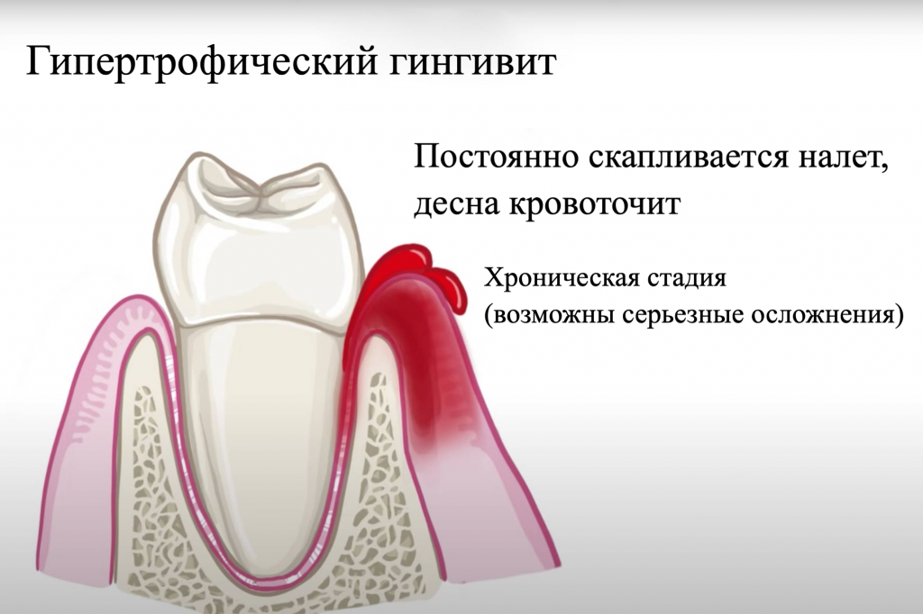 Гингивит у детей — причины, симптомы, виды в статье журнала о стоматологии startsmile