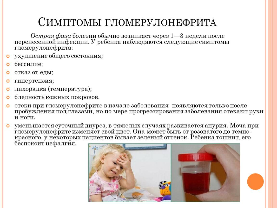 Гломерулонефрит у детей: виды, симптомы, лечение и профилактика
