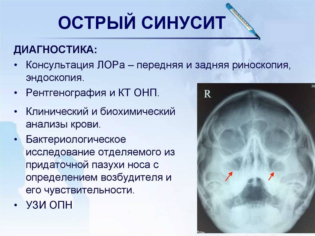 Как лечить синусит у ребенка? симптомы и признаки синусита у детей
