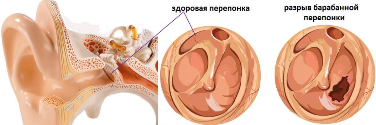 Экссудативный отит — как предотвратить потерю слуха у ребёнка
