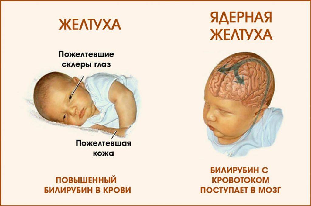 Младенческая желтуха: симптомы, методы лечения, последствия для новорожденных