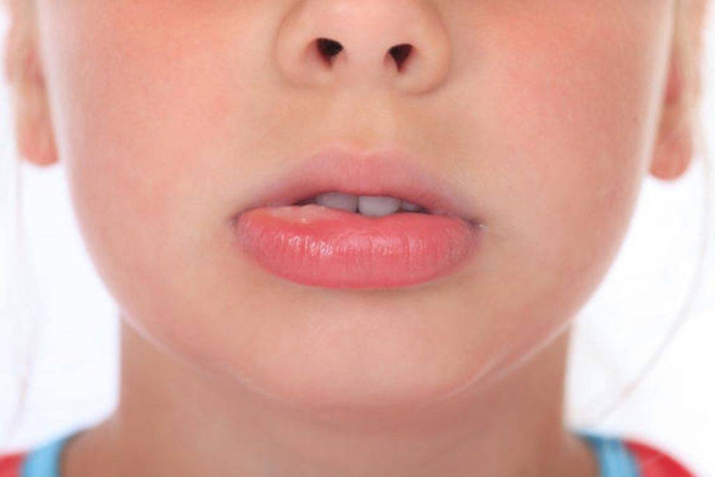 У ребенка опухла губа: причины, сопутствующие симптомы и лечение