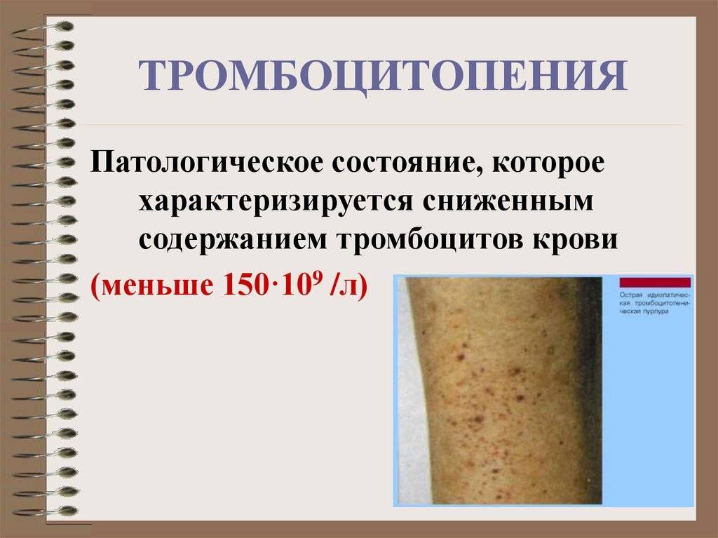 Васкулит геморрагический