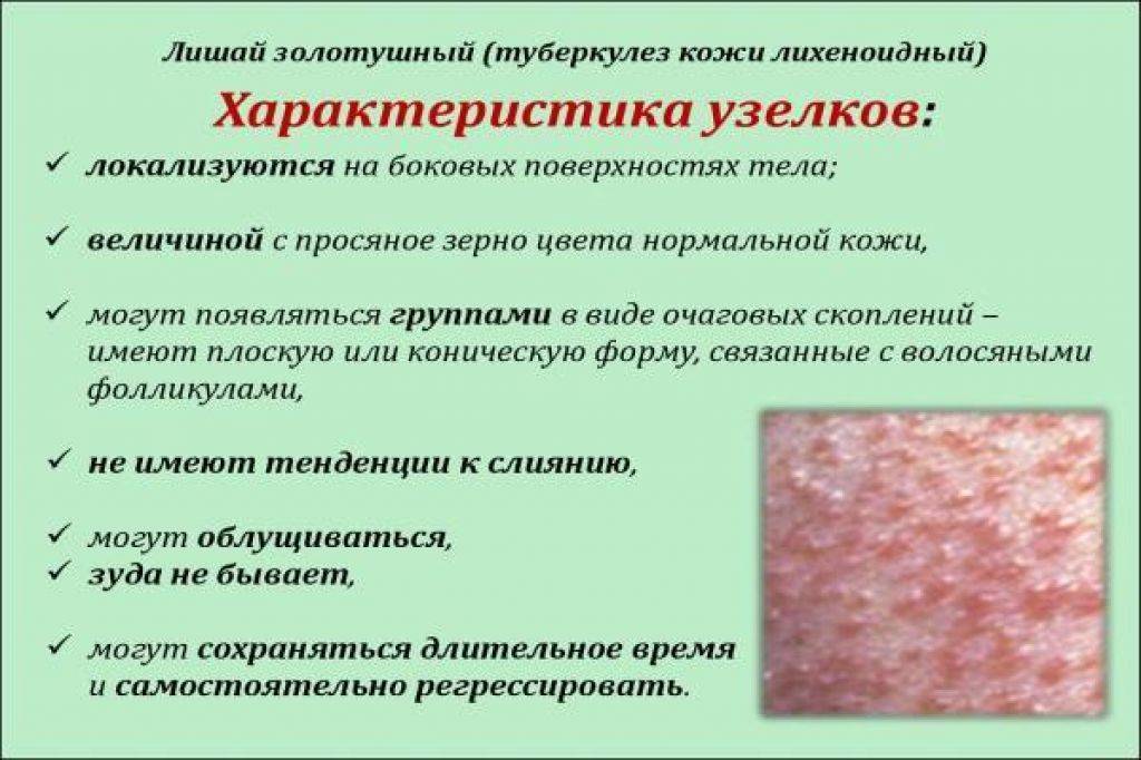 Инфекционный (вирусный) дерматит: 6 фото с описанием, лечение, причины и симптомы