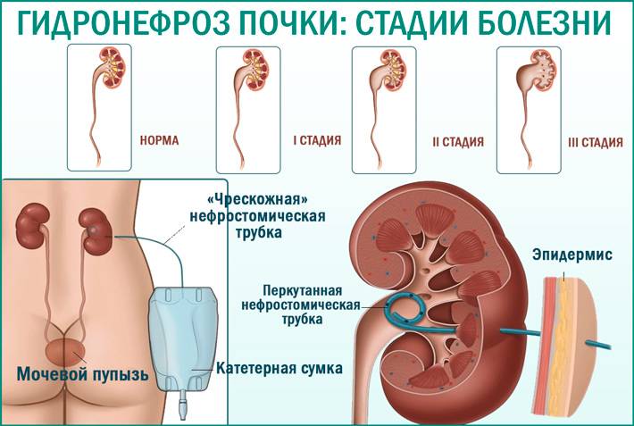 Гидронефроз у детей: причины возникновения, диагностика, лечение и профилактика заболевания