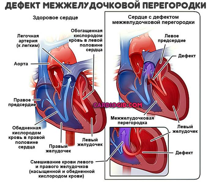 Дефект межжелудочковой перегородки (дмжп) – диагностика и лечение