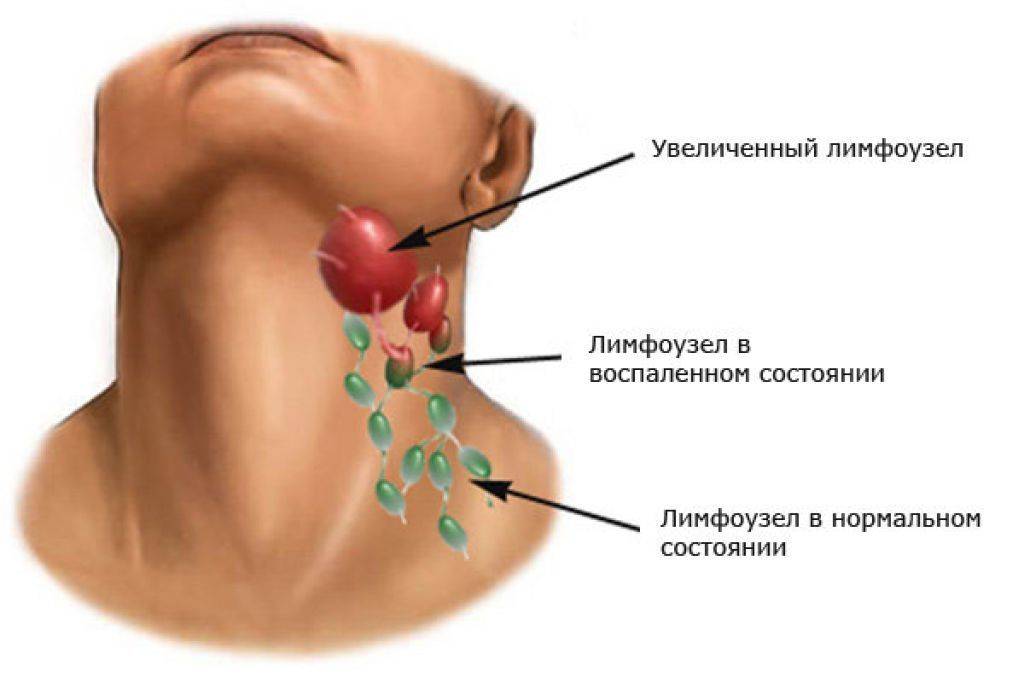 У ребенка воспалился лимфоузел за ухом: причины, как лечить