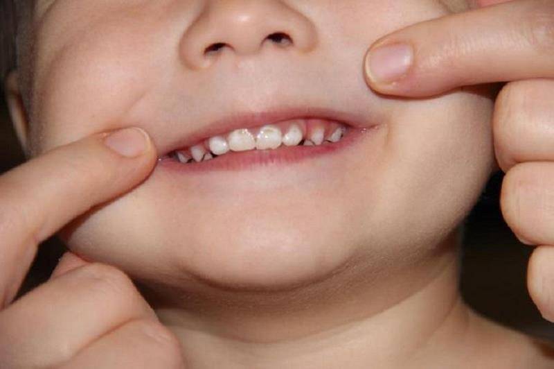 Черный налет на зубах у ребенка — налет пристли