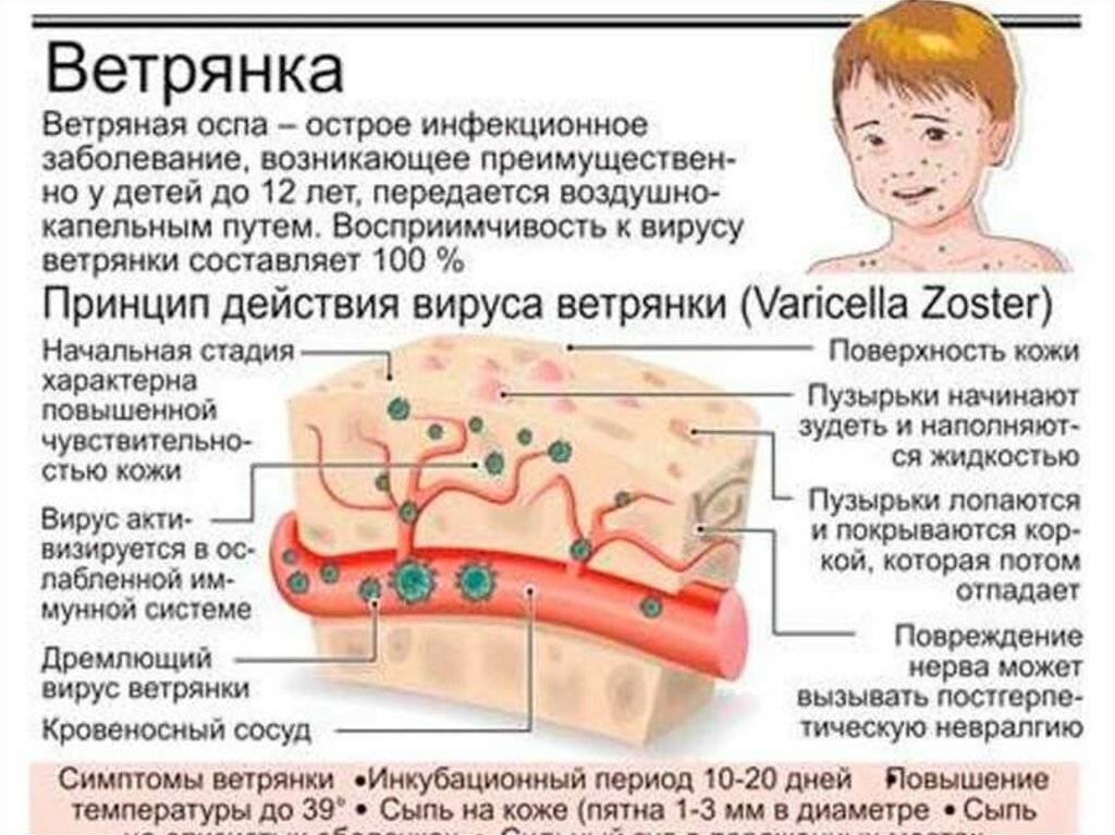 Ветрянка – причины, симптомы и диагностика, медикаментозное лечение ветряной оспы у детей и у взрослых, диетическое питание, фото. через сколько дней после заражения появляются первые признаки заболевания? помогает ли прививка от ветрянки?