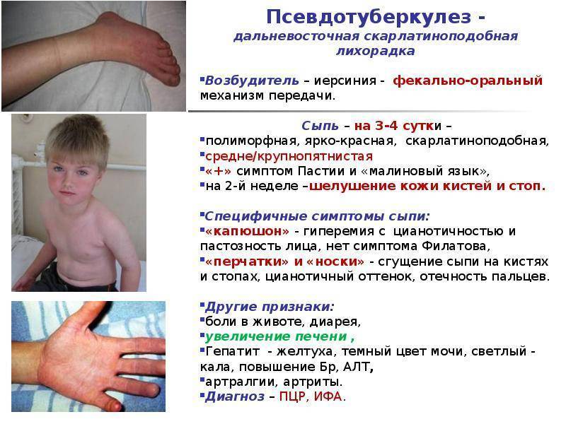 Как выглядит аллергическая сыпь? кожные высыпания у ребенка