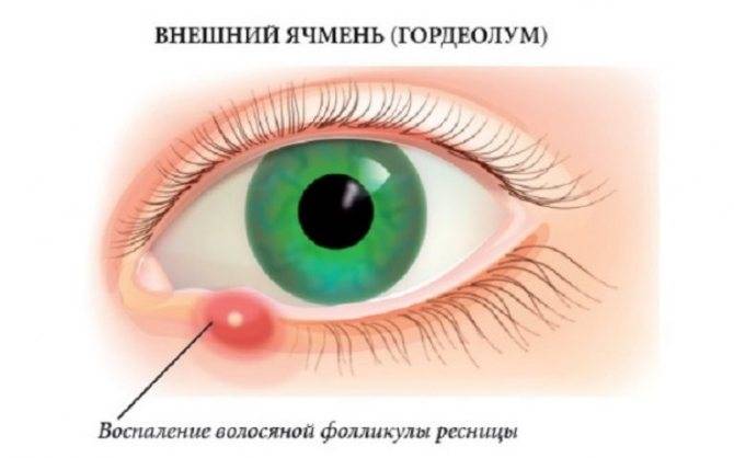 Халязион на веке: лечение, удаление, причины халязиона на глазу