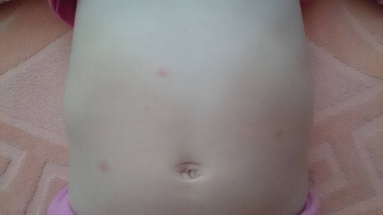 Сыпь у новорожденного и грудничка 📌 в виде прыщиков на лице и по всему телу: фото с пояснениями