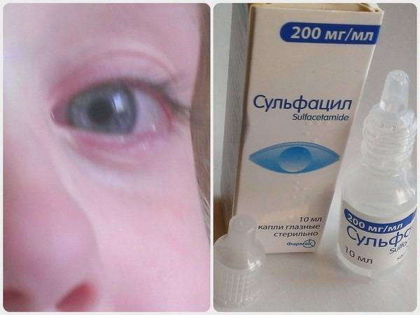 Конъюнктивит при беременности: чем лечить глаза и что можно, а также опасен ли для плода, какие капли использовать при вирусной форме