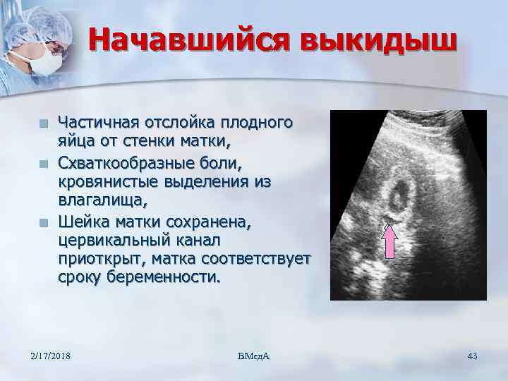 Можно ли предотвратить самопроизвольное абортирование (выкидыш)