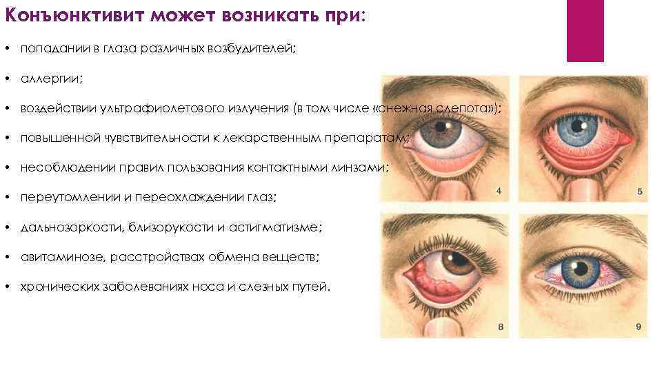 Бактериальный конъюнктивит: лечение у детей, симптомы заболевания глаз, вирусный, острый и другие