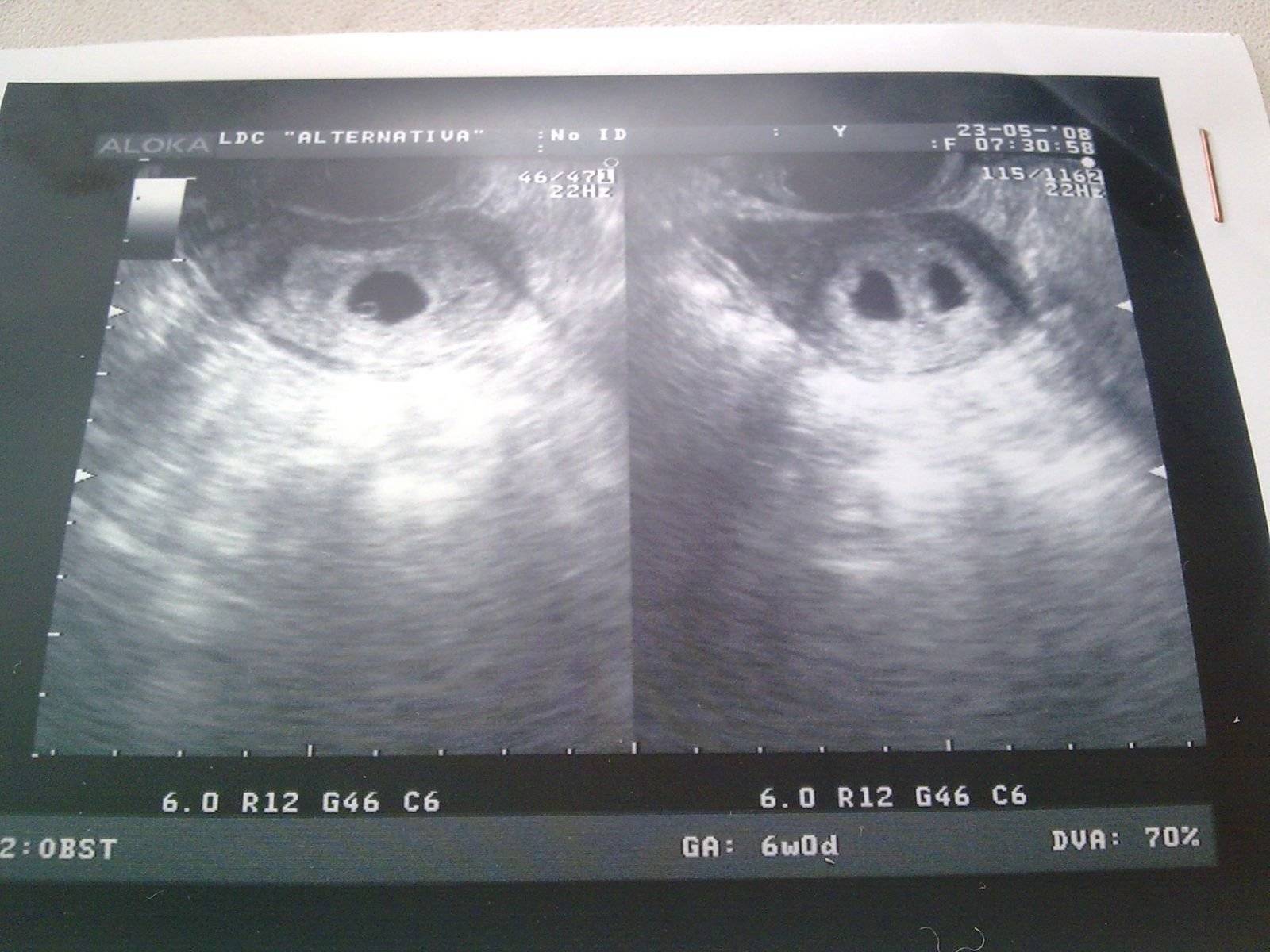 Беременность 4 недели видна на узи. УЗИ на 4 неделе беременности двойня. УЗИ двойни на ранних сроках 4 недели. УЗИ 5 недель беременности двойня однояйцевая. Многоплодная беременность 4 недели УЗИ.