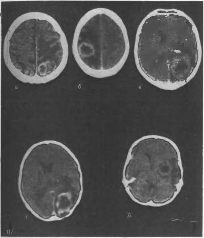 Опухоль головного мозга у детей: симптомы ранних и поздних стадий, прогноз диффузной глиомы ствола