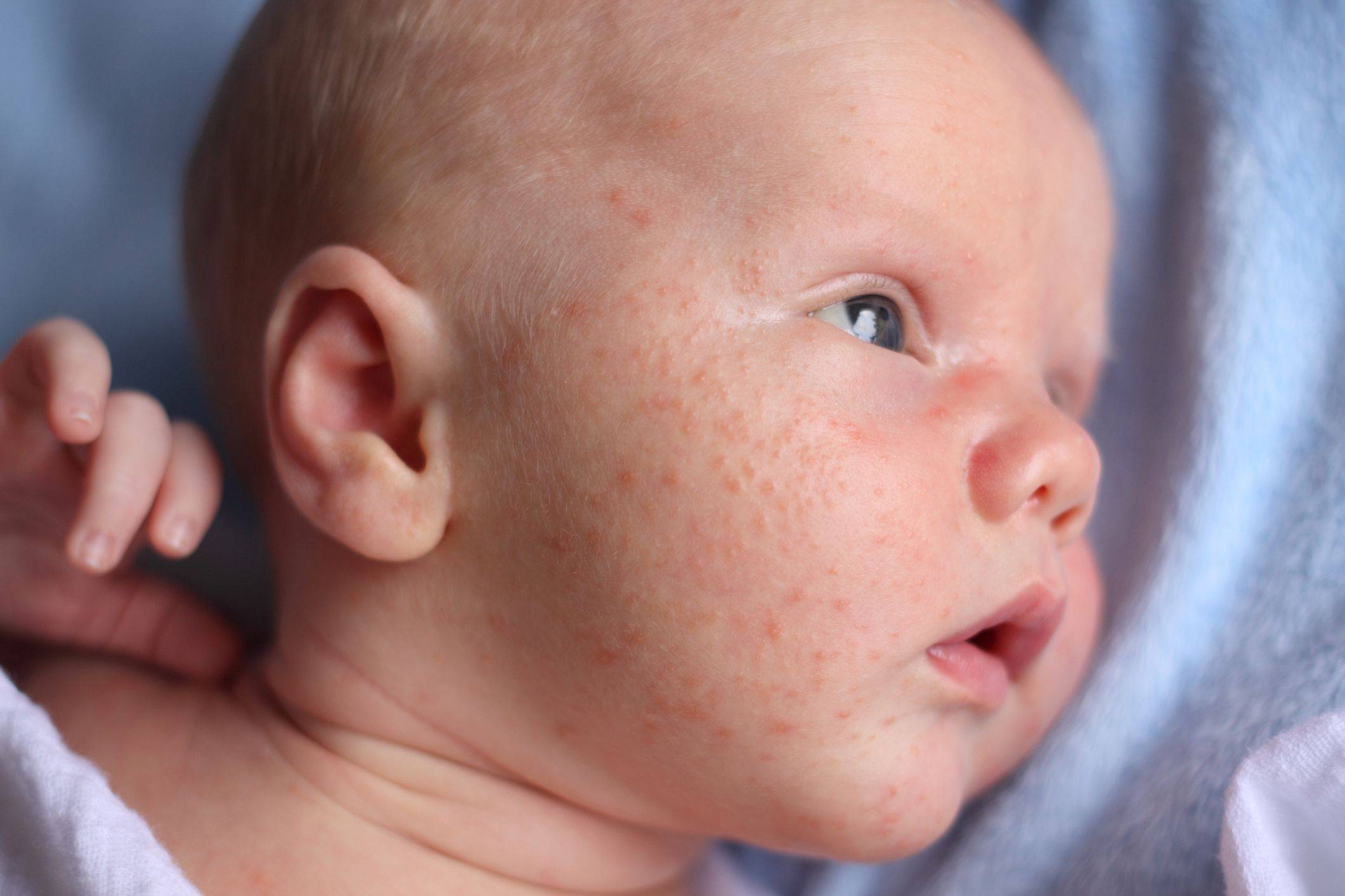 Почему появляется аллергия у грудного ребенка на лице и чем лечить?