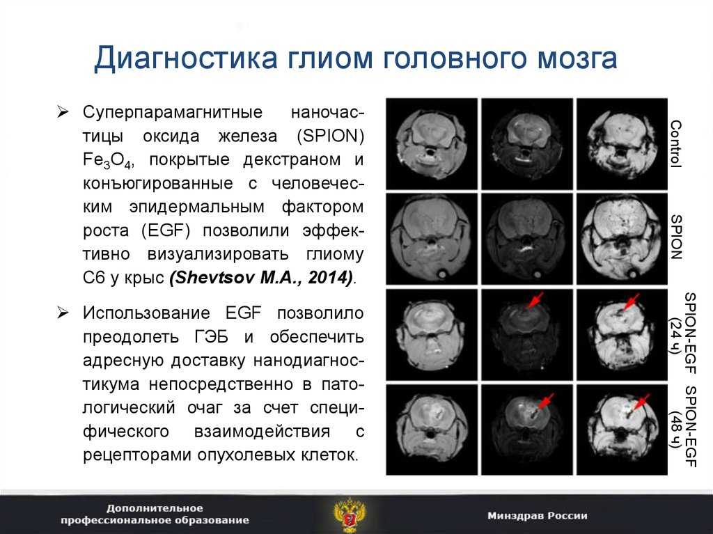 Опухоли головного и спинного мозга у детей и подростков - вместе by st. jude