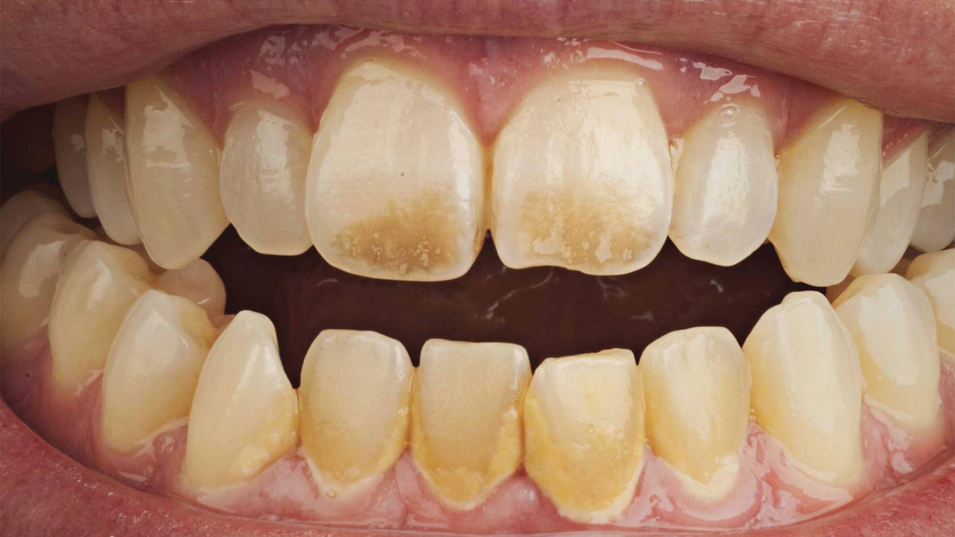 Черный налет на зубах у ребенка — почему образуется и как убрать налет пристли на молочных зубах у детей?