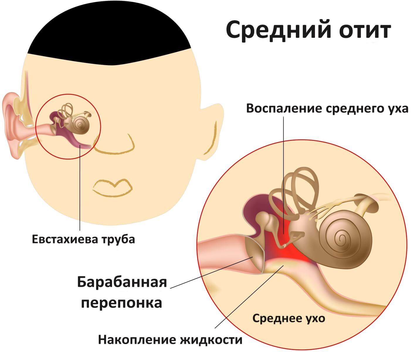 Неприятный запах из уха у грудничка: возможные причины его появления у ребенка и способы устранения