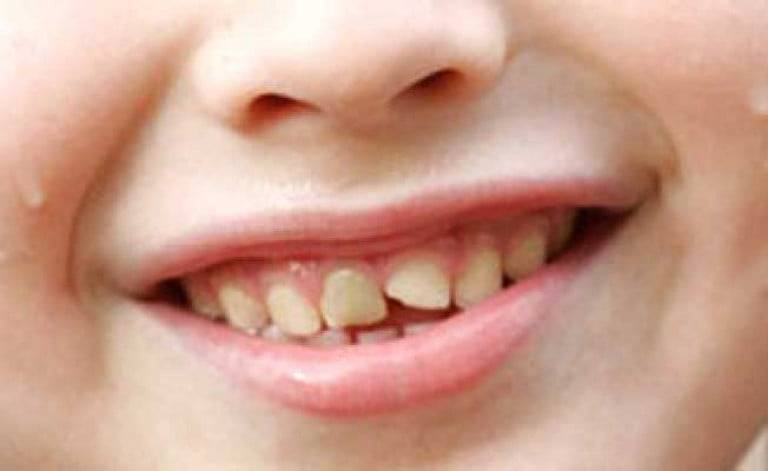 После удара потемнел молочный зуб у ребенка: причины и отзывы | za-rozhdenie.ru