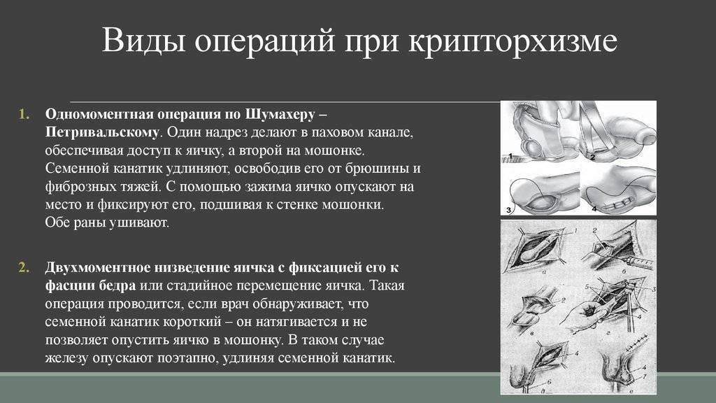 Симптомы гипоплазии яичек у мальчиков, причины дисфункции и схема лечения
