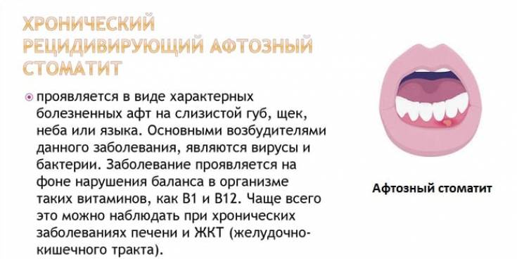 Афтозный стоматит у детей - профилактика и способы лечения