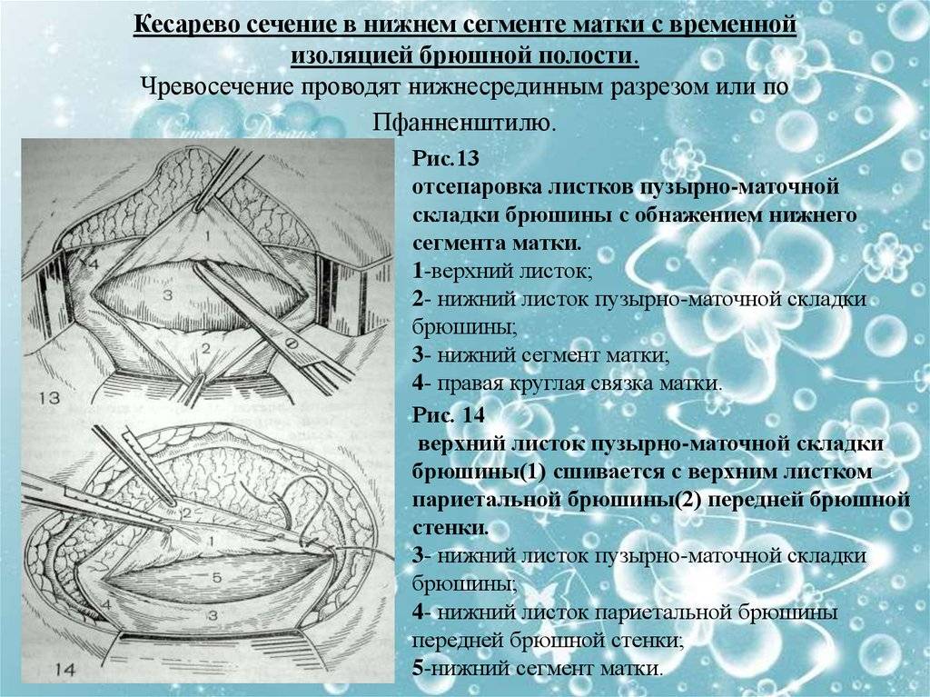 Плановое кесарево сечение: подготовка и особенности