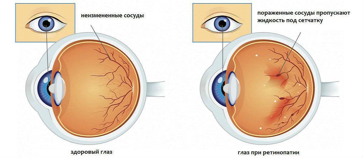 Ангиопатия сетчатки глаза у детей