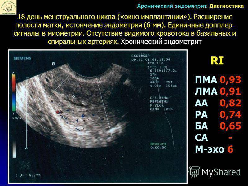 Гиперплазия эндометрия симптомы и лечение, беременность, менопауза | доктор субботин