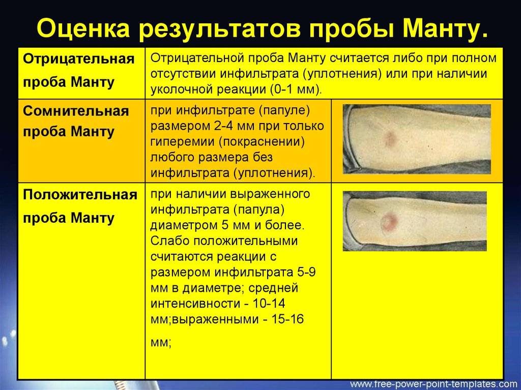 Манту при насморке — ставить ребенку или нет