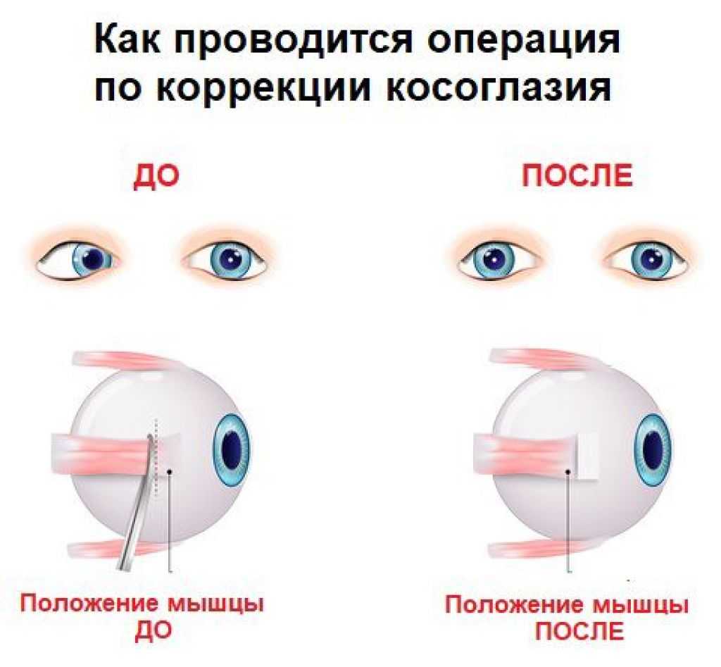 Склеропластика глаз