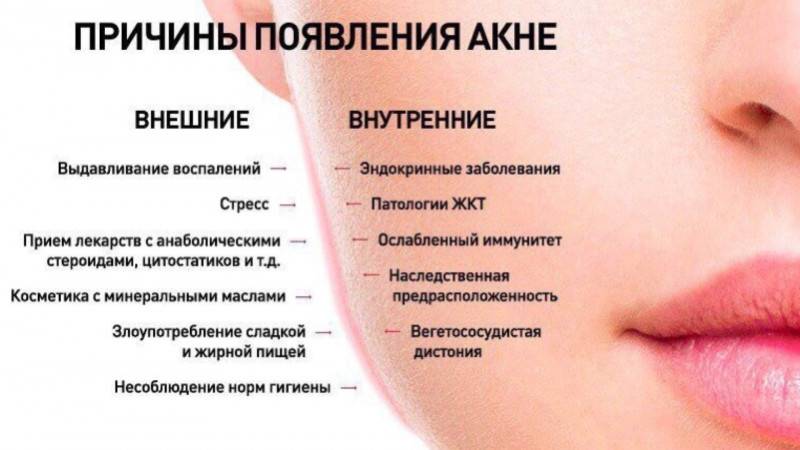Гормональные прыщи на лице: что такое, как выглядят, причины появления сыпи, как лечить, профилактика