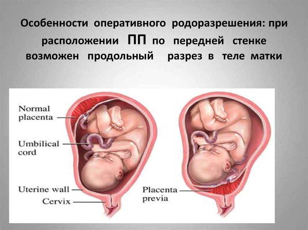 Низкая плацентация при беременности | уроки для мам