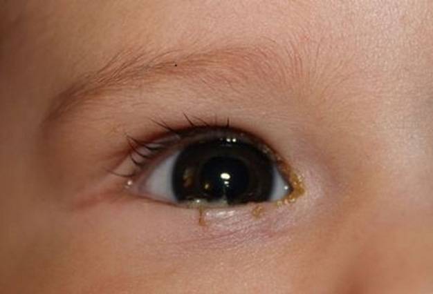 Закисание глаз у ребенка: причины и способы лечения